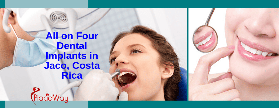 Affordable Treatment for All on 4 Dental Implants in Jaco, Costa Rica